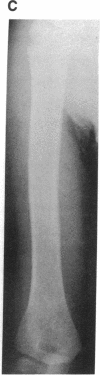 1915