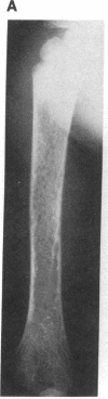 1915