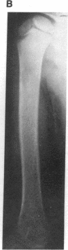 1915